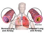 Bronchial Asthma caused by an allergic reaction in the lungs