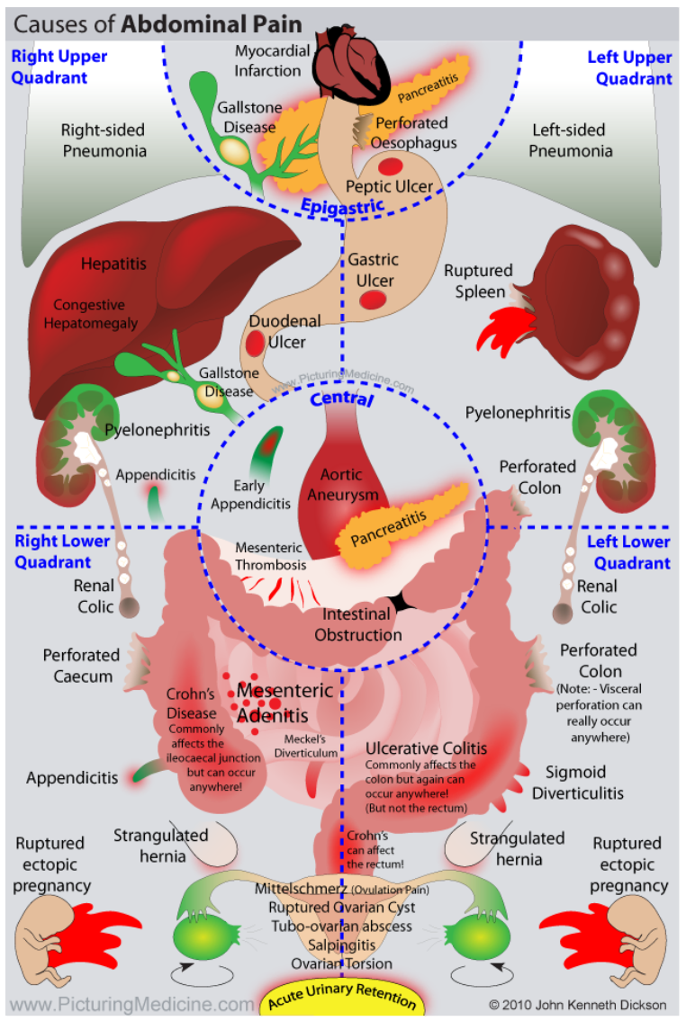 Top 5 Causes Of Severe Upper Abdominal Pain Abdominal Vrogue co