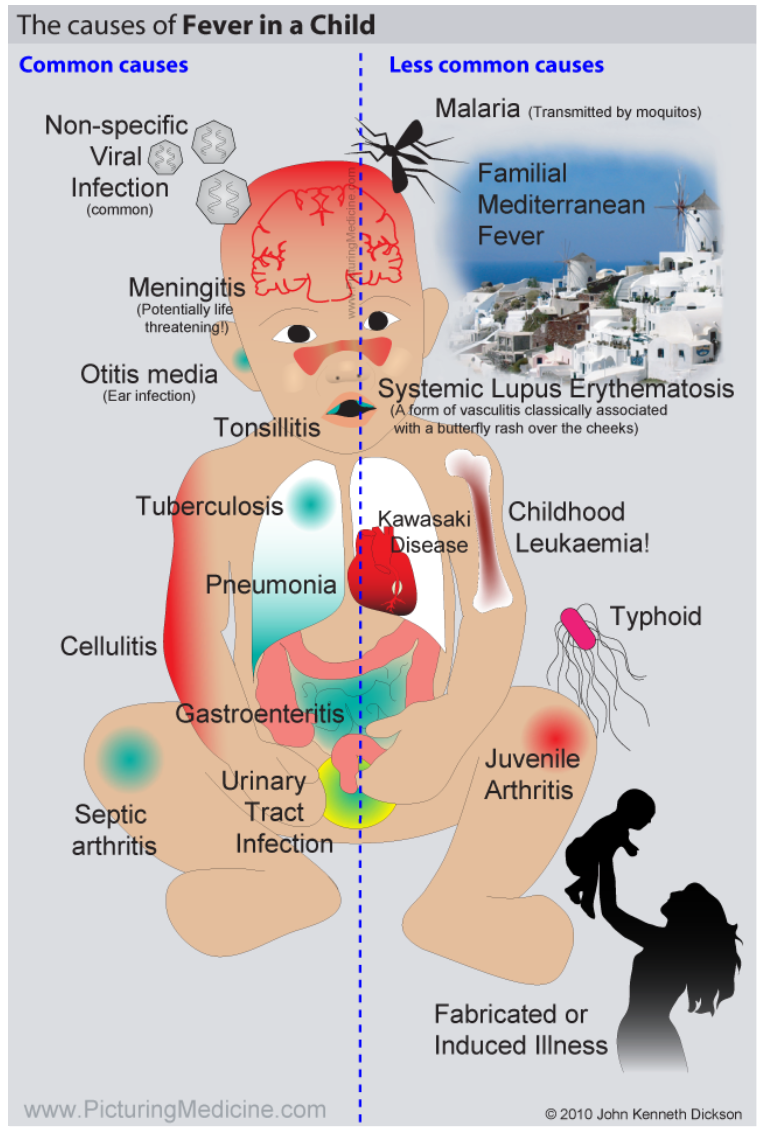 What Are Febrile Convulsions 