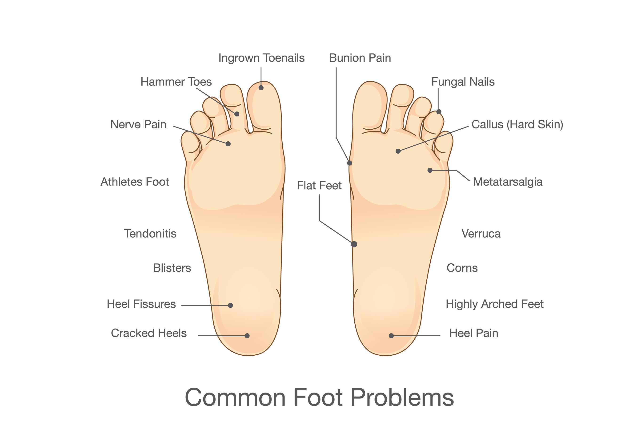 Why pimple bottom foot sole