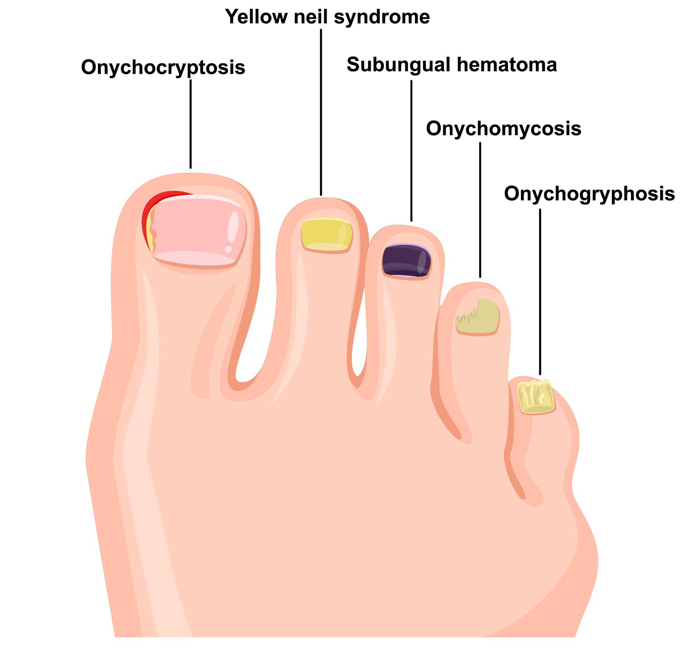 Common Nail Diseases