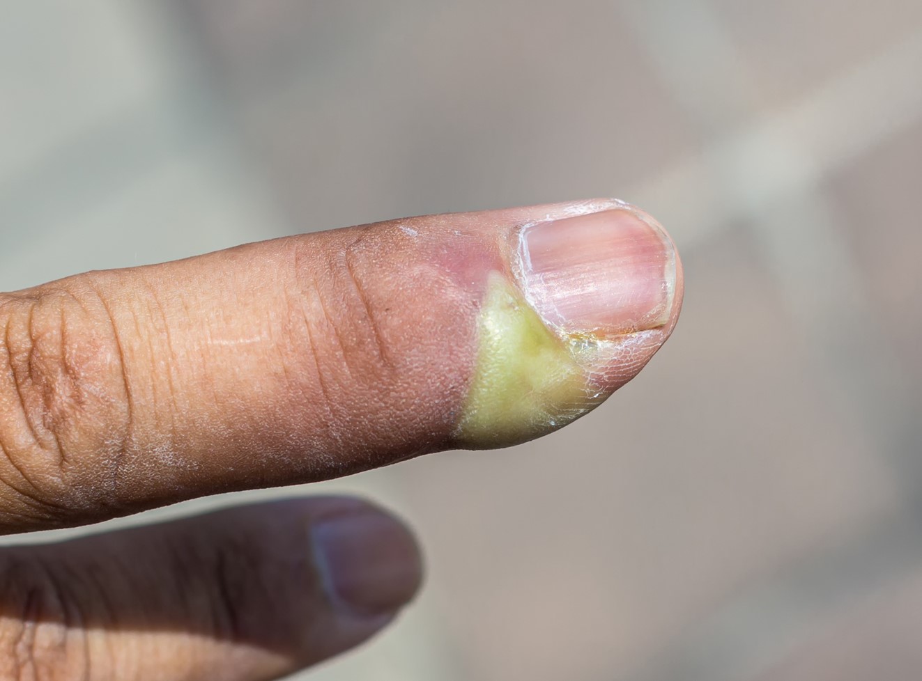 Why Is Part Of My Fingernail Green At Doris Vanburen Blog