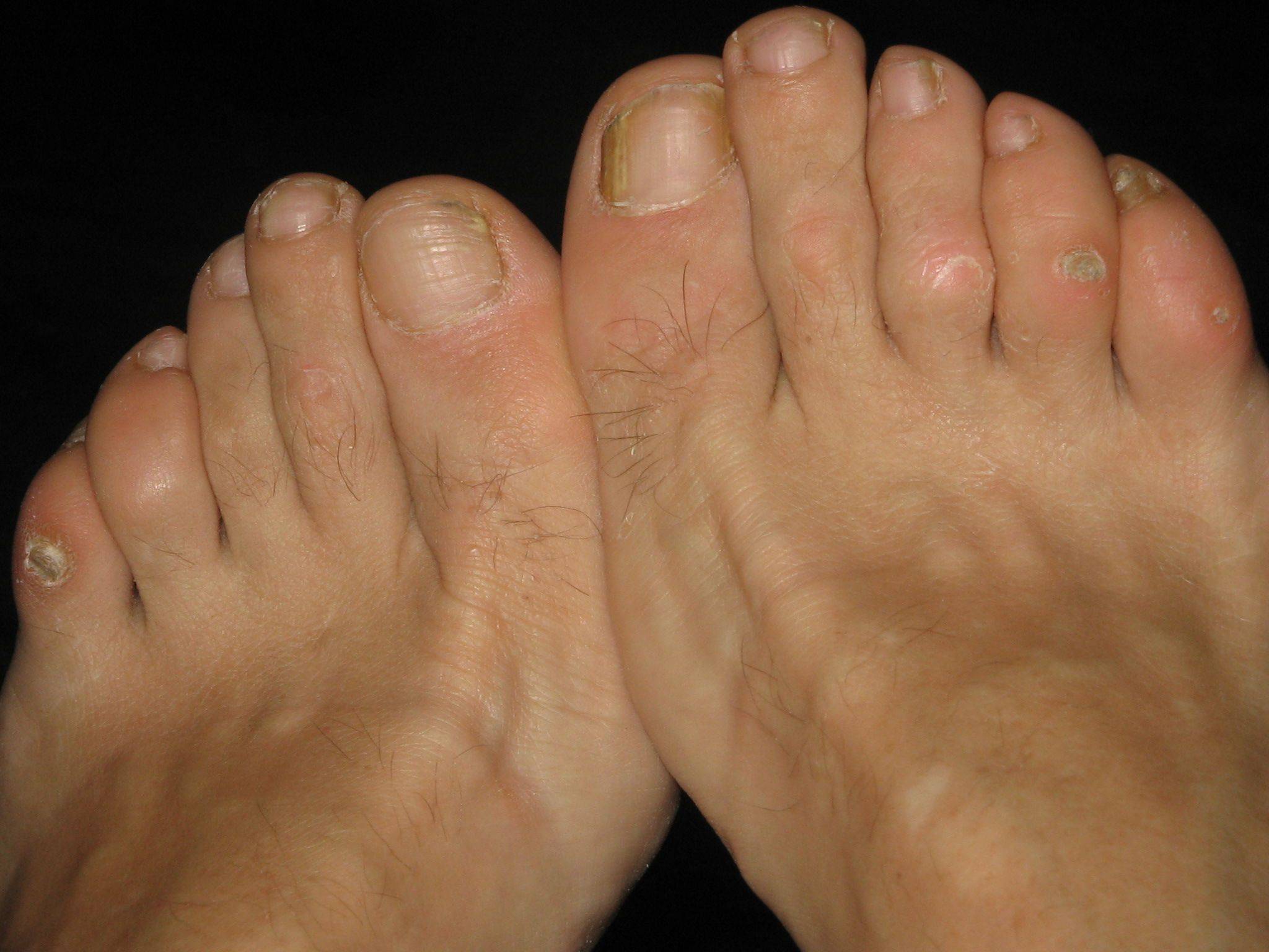 What Causes Foot Calluses & Corns? Treatment & Prevention
