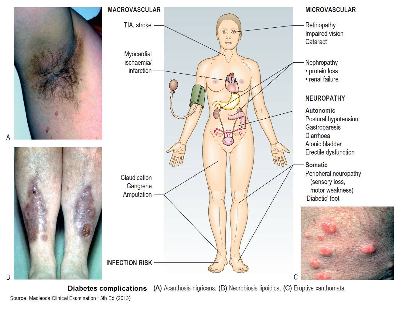 What is Diabetes Mellitus, Prediabetes and Insulin resistance