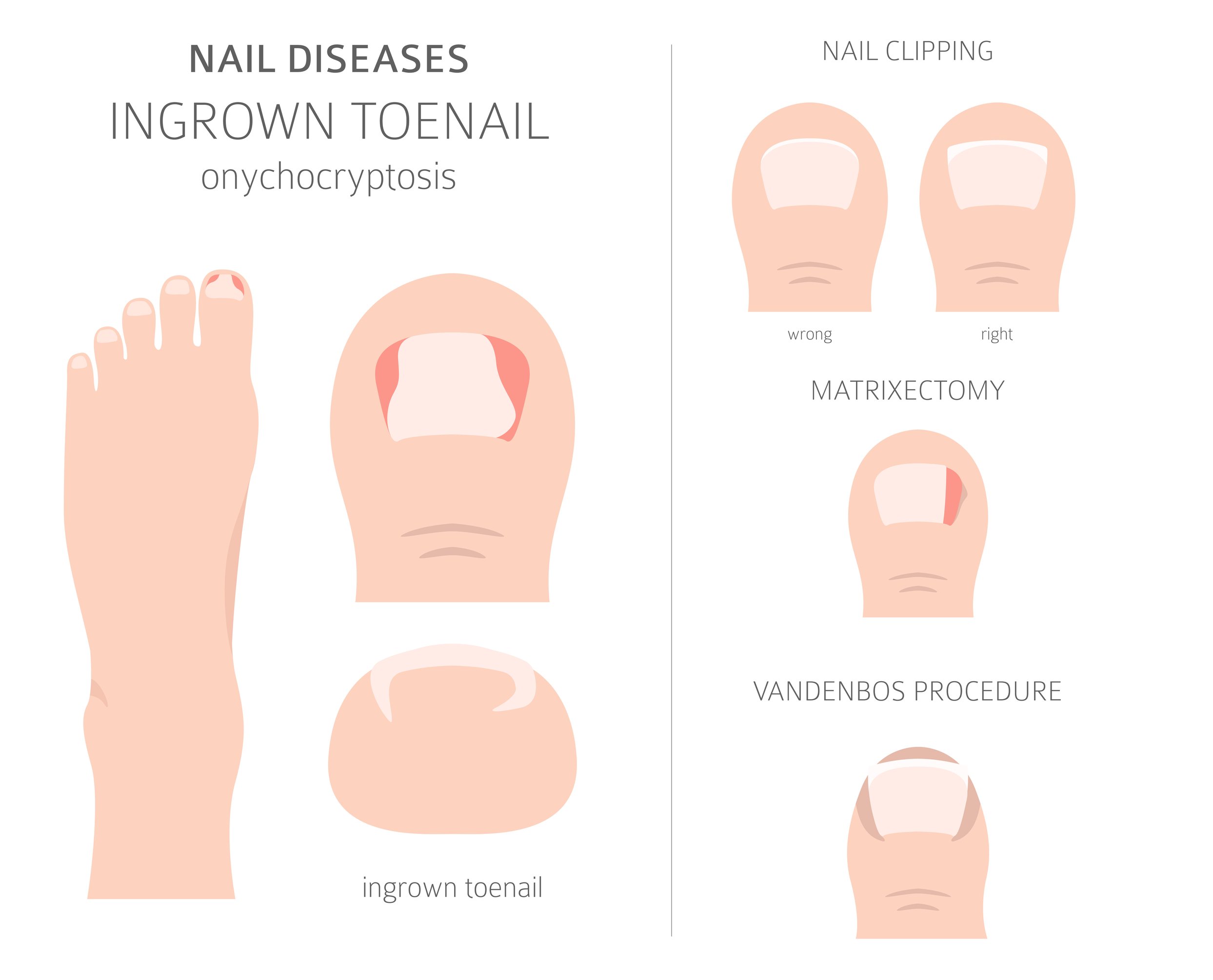 Ingrown toenail causes - Medical treatment AIPC Tel: 6694 1661